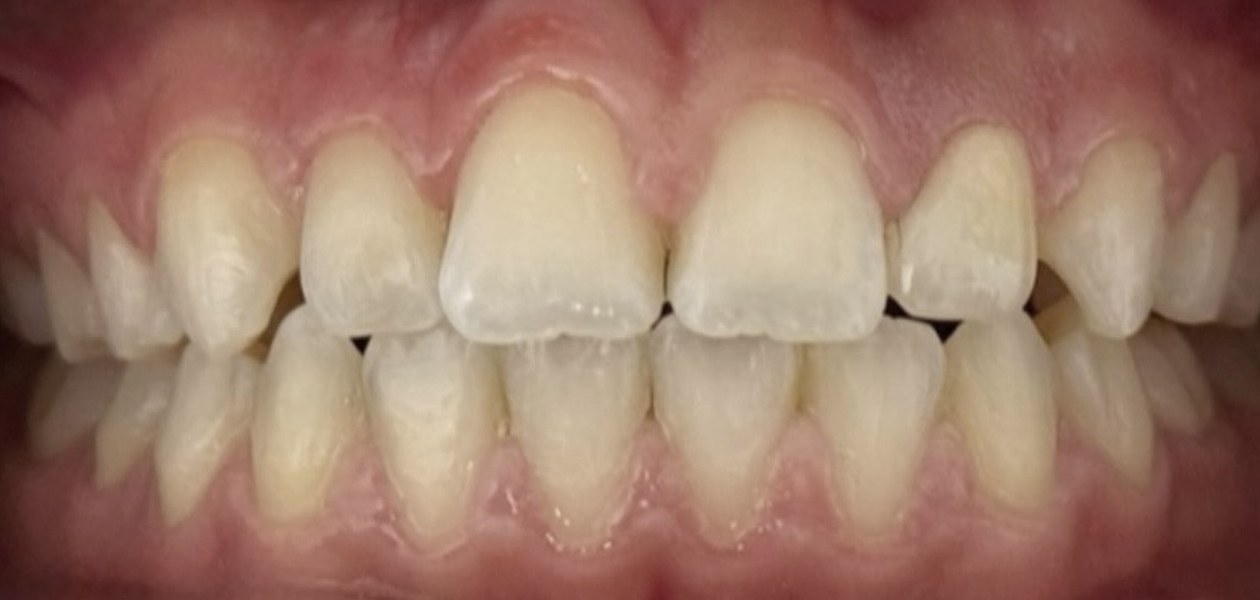 After treatment, porcelain crown for a peg lateral