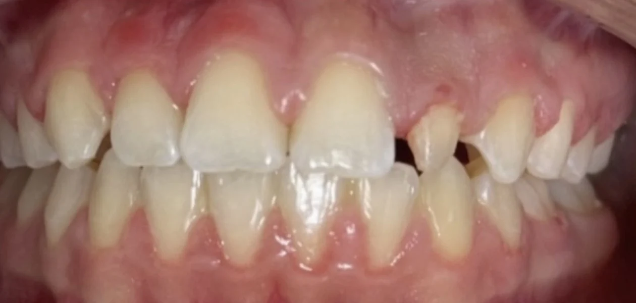 Before treatment, porcelain crown for a peg lateral
