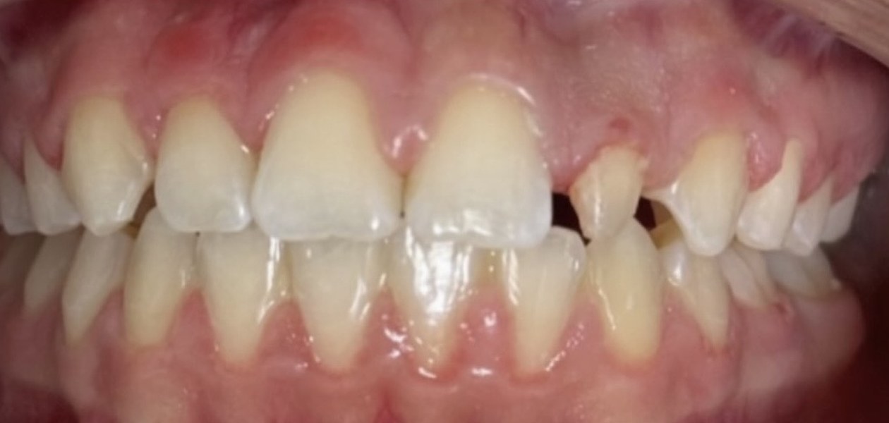 Before treatment, porcelain crown for a peg lateral