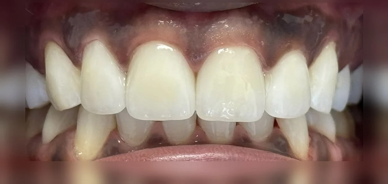 After treatment, veneer and whitening