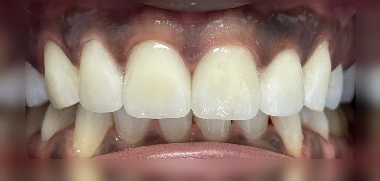 After treatment, veneer and whitening