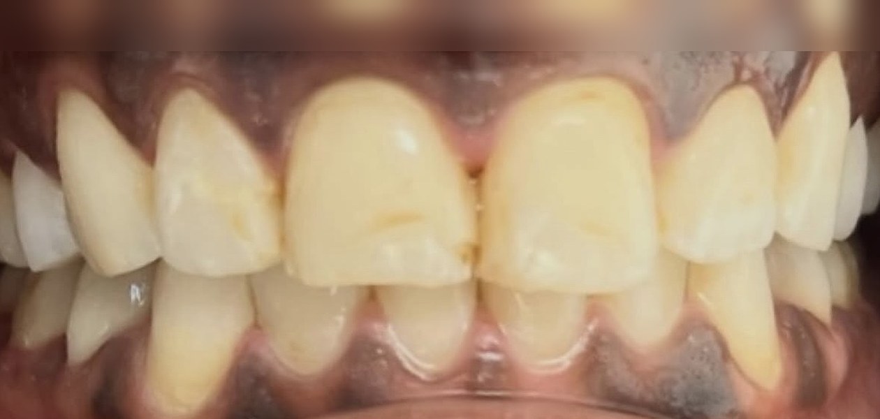 Before treatment, veneer and whitening