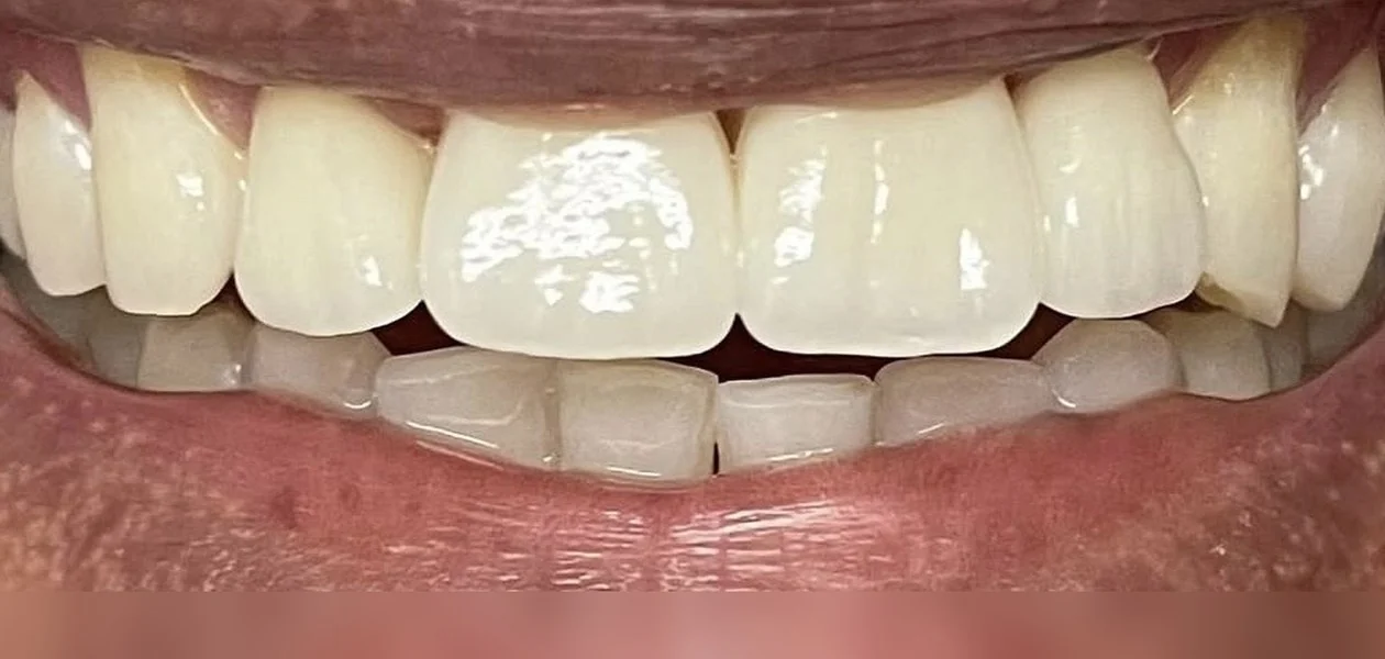 After treatment, veneers for chips and fractures