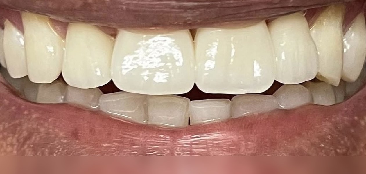 After treatment, veneers for chips and fractures