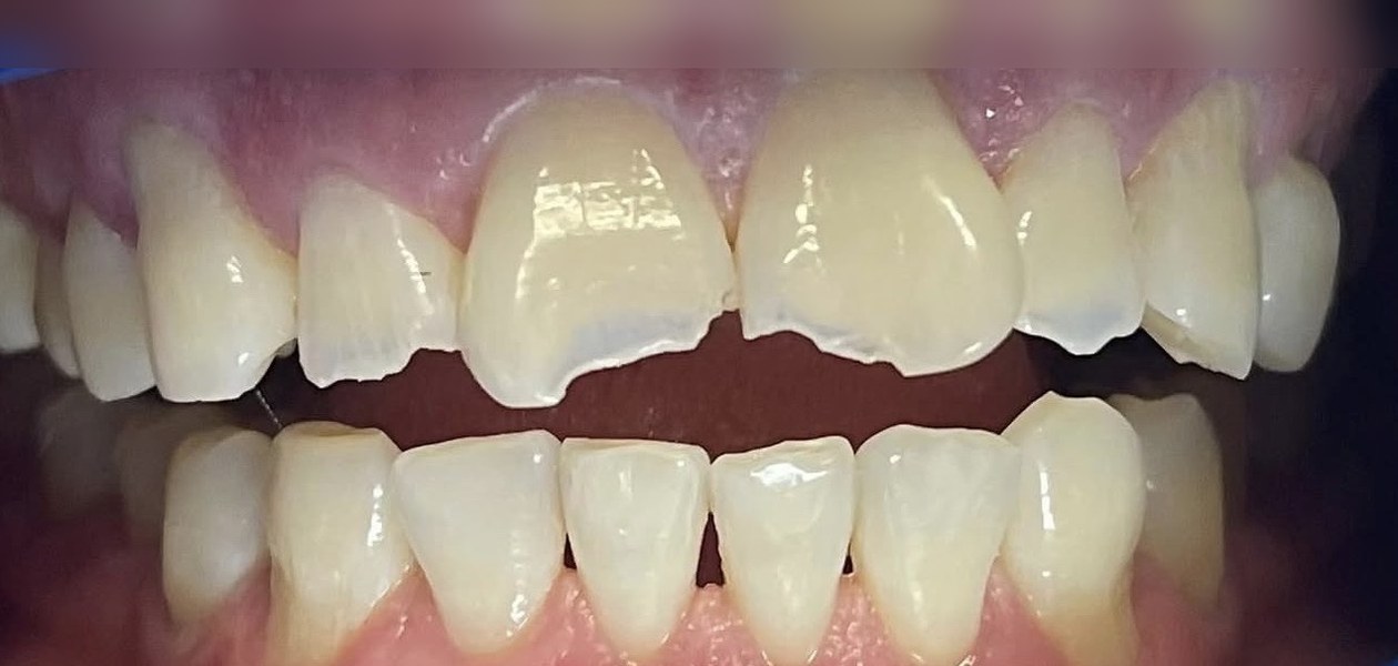 Before treatment, veneers for chips and fractures