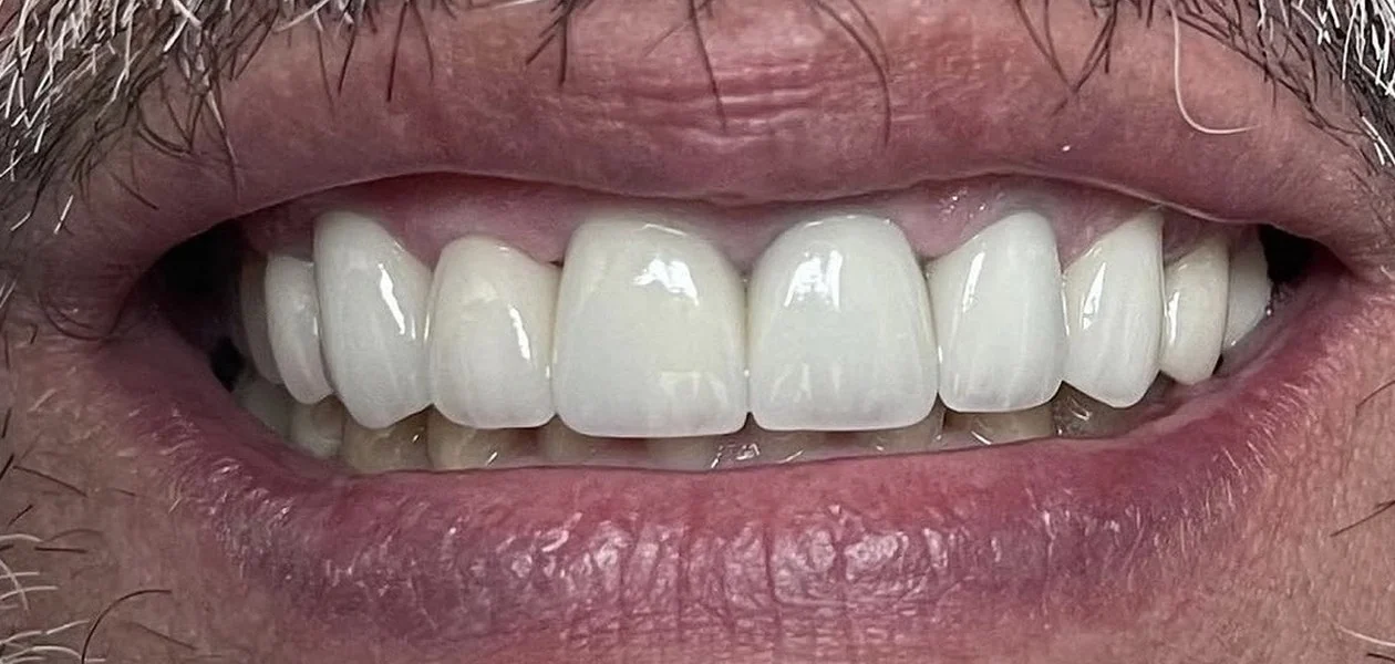 After treatment, crowns, veneers and gum recontouring