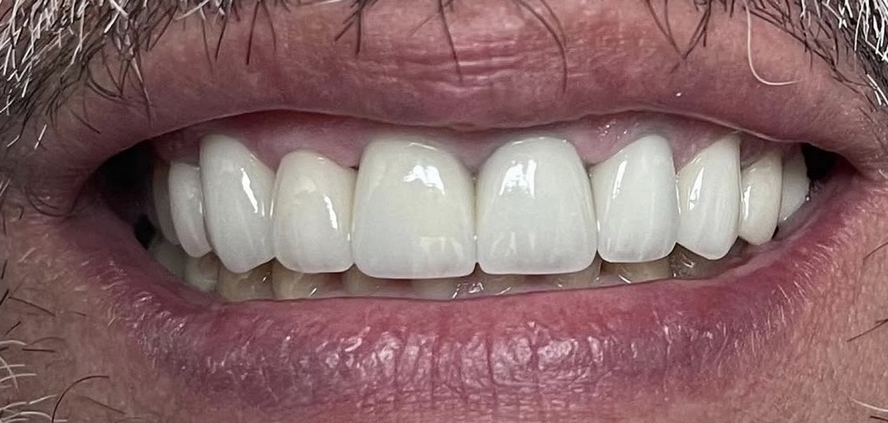 After treatment, crowns, veneers and gum recontouring