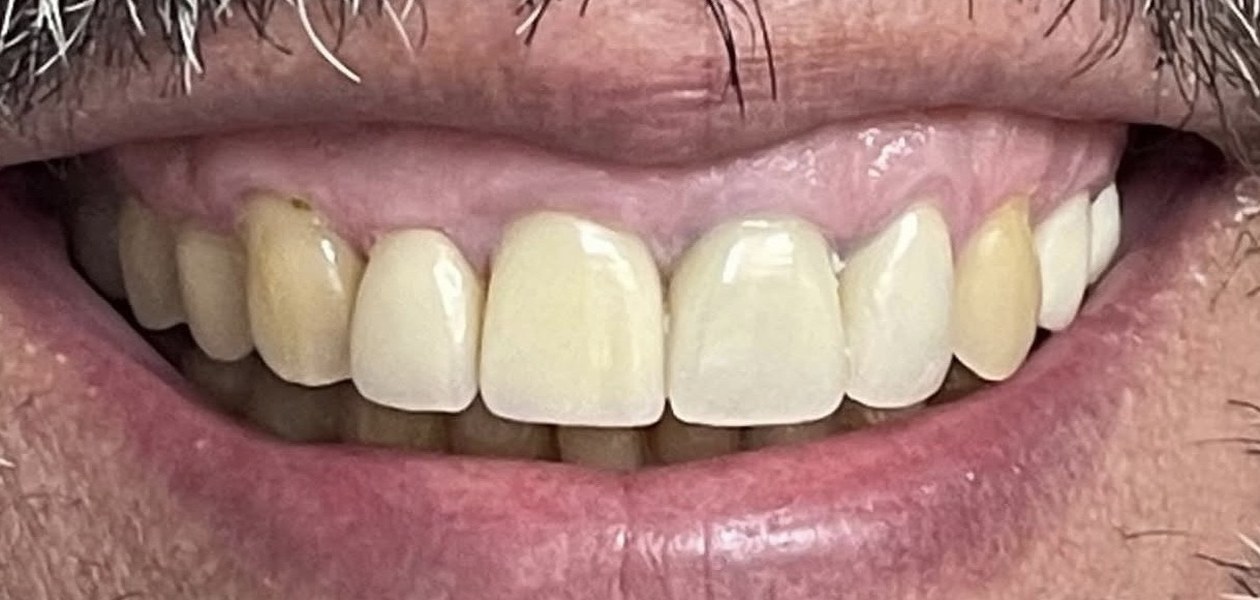 Before treatment, crowns, veneers and gum recontouring