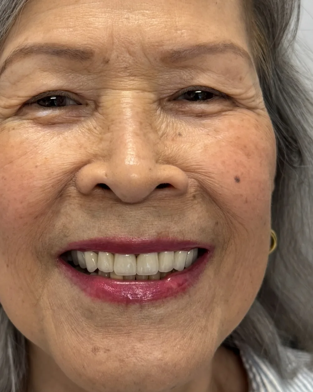 After treatment, upper and lower restorations