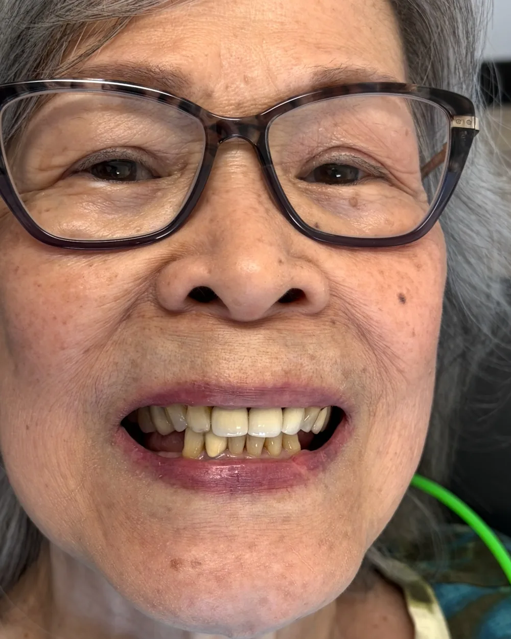 Before treatment, upper and lower restorations